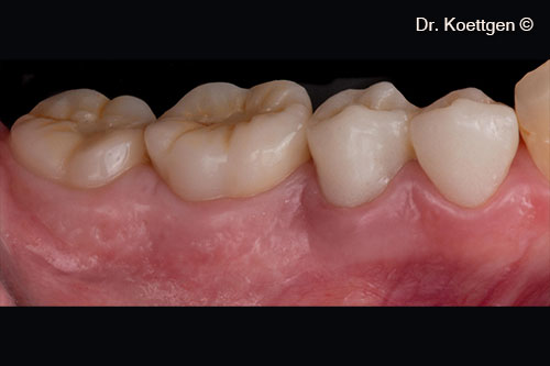 7. Long term provisional for initial loading and emergence profile contouring