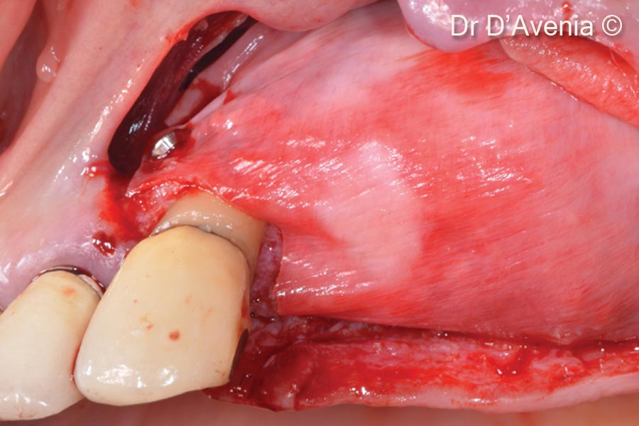 6. OsteoBiol® mp3® (second layer) and OsteoBiol® Evolution membrane