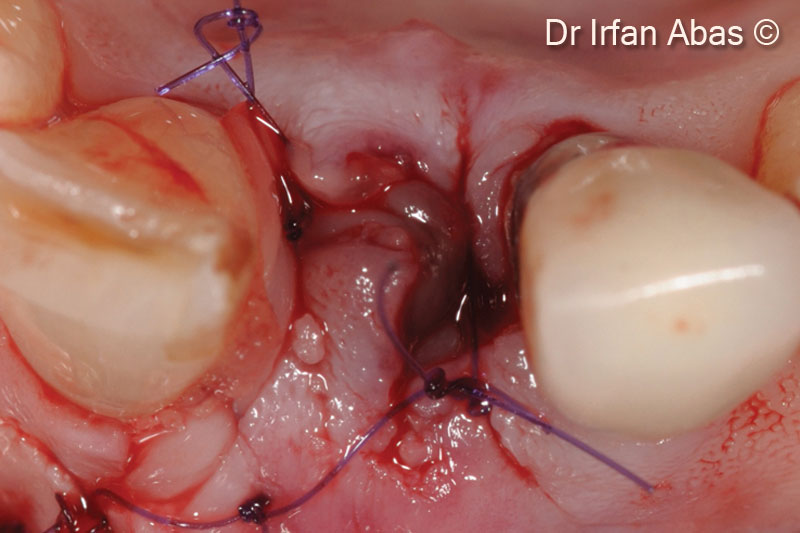 10. Occlusal view of the suture