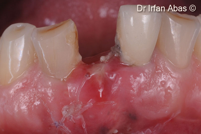 11. Two weeks post-operative clinical view