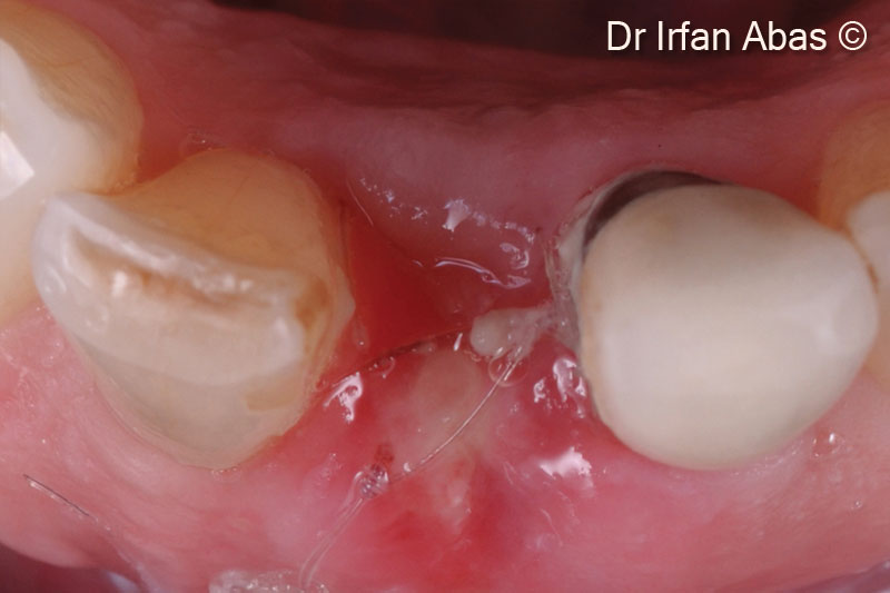 12. Two weeks post-operative clinical view