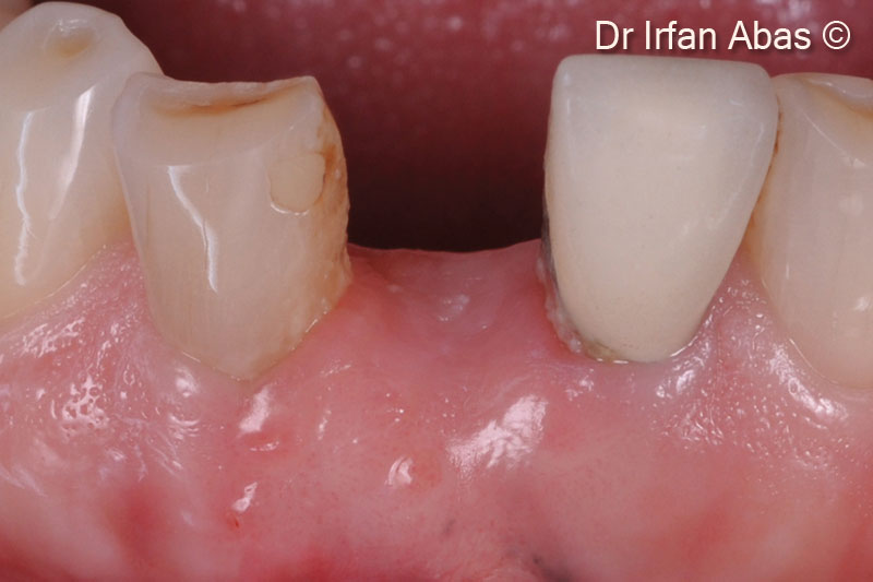 13. One month post-operative clinical view