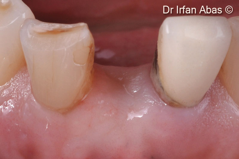 14. Thee-month post-operative clinical view