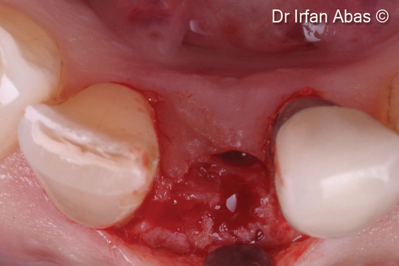 15.Newly formed bone before implant insertion