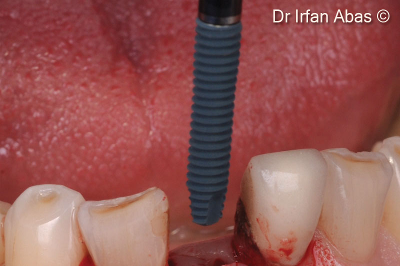 16. A Megagen mini-implant is inserted into newly formed bone