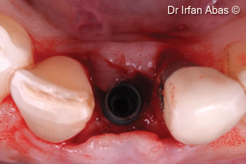 17. Torque 35 N cm-2