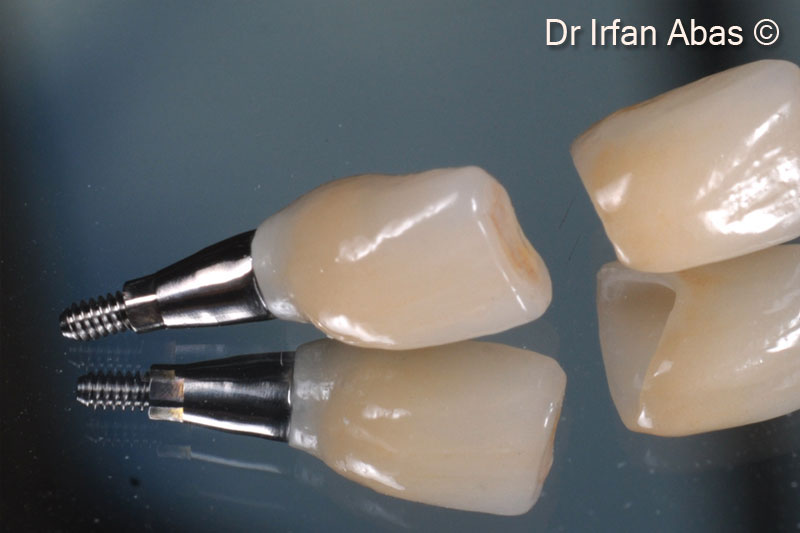 19. Ceramic crowns