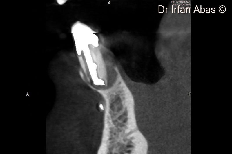 2. The CBCT shows a lingual and palatal bone defect