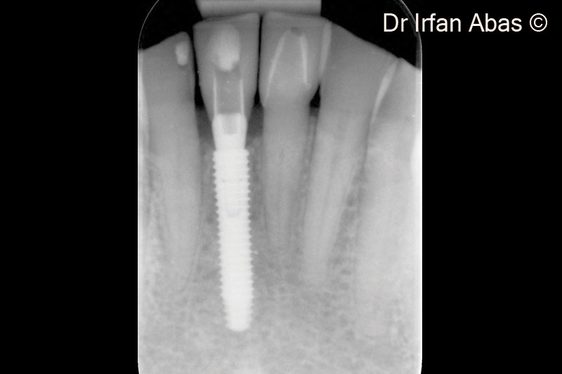 21. X-ray check after four months