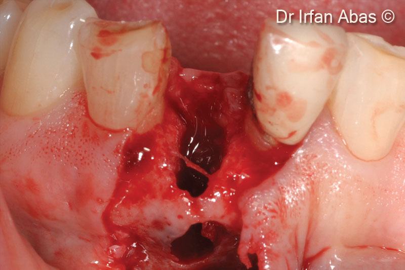 3. Clinical view of the palatal defect