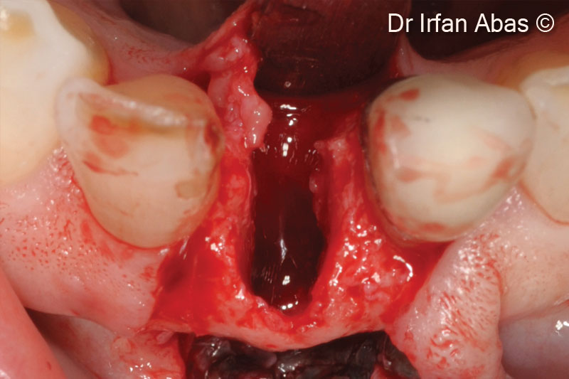 4. Clinical view of the lingual defect