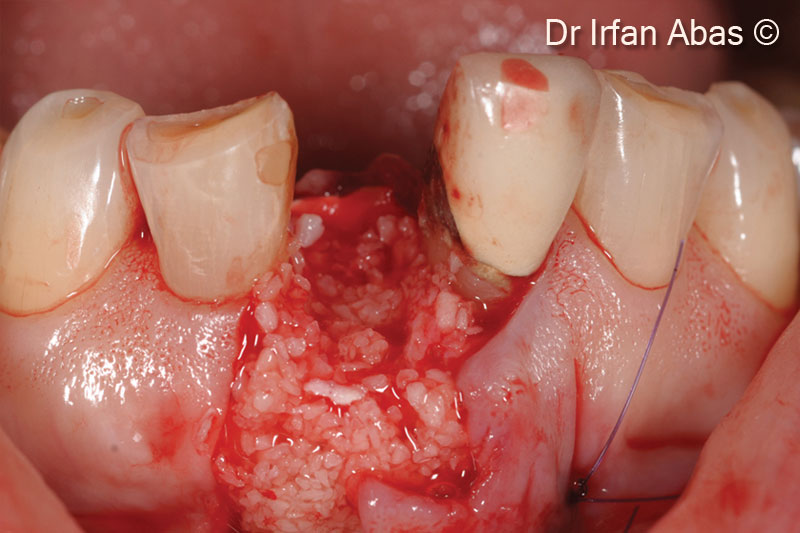 5. Gen-Os® is grafted into the defect site. An Evolution membrane is used to stabilise the graft