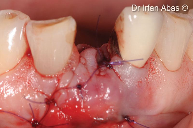 9. The flap is sutured
