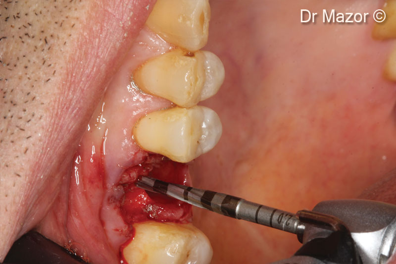 7. 2-mm densifying drill reaching sinus floor