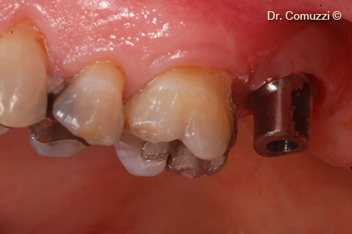 10. Implant Abutment