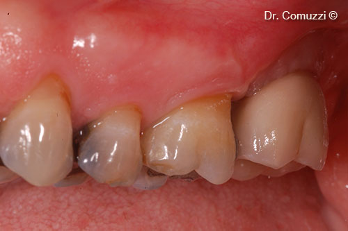 11. Case completed with 27 in place