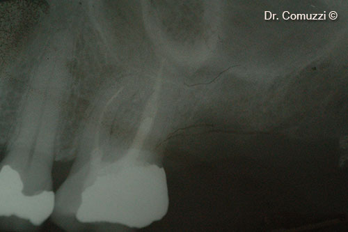 2. Initial vertical bone