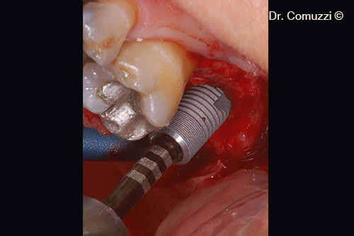 4. Implant insertion (Astra, 9-mm length and 5-mm diameter)