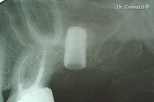6. X-ray of Sinus Lift at implant placement