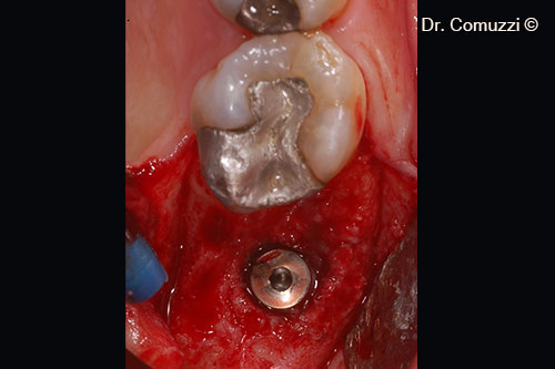 7. Cover screw application