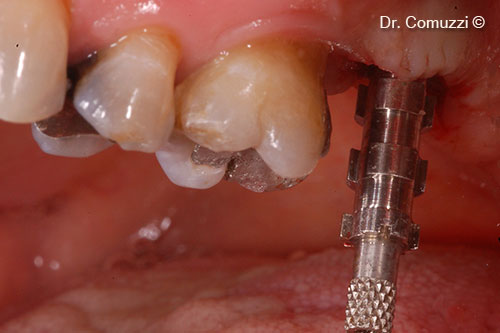 8. Impression coping