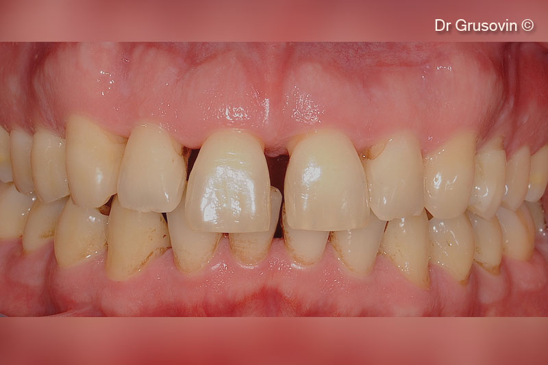1. Healthy patient, non smoker intraoral clinical view buccal