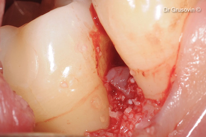 12. OsteoBiol® Gen-Os® to fill the two-wall defect. The papilla is not elevated