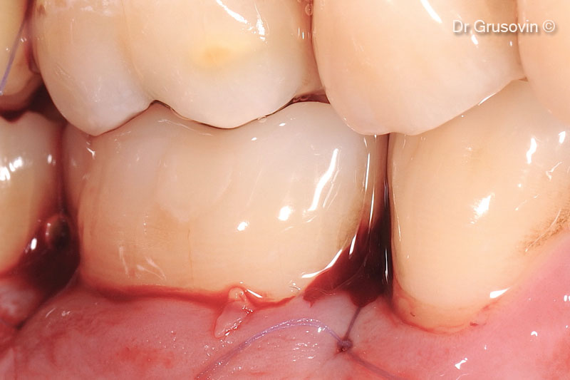 13. Single flap closure