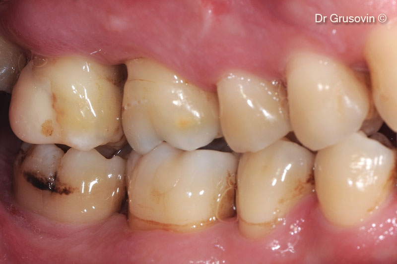 14. Clinical view at 7 years follow-up