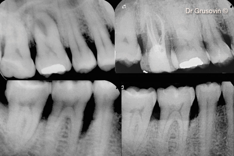 15. X-rays of baseline vs 7 years follow-up