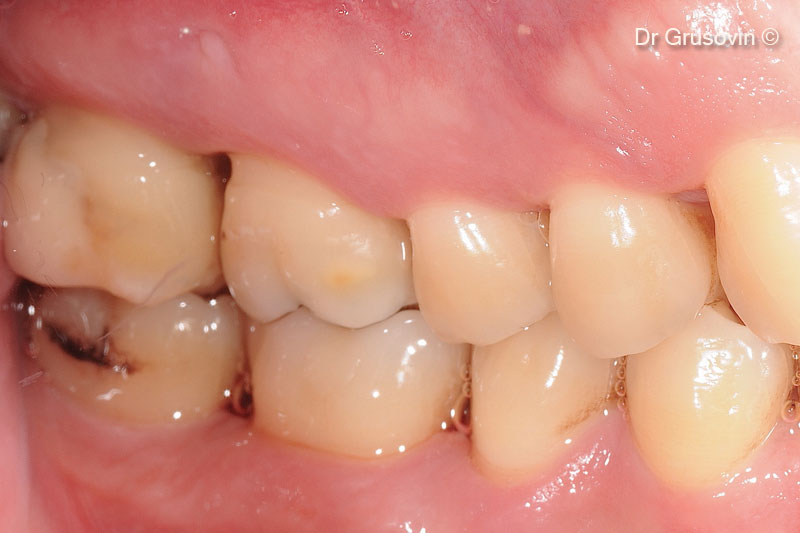 2. #16 vital, furcation III involvement vestibular distal