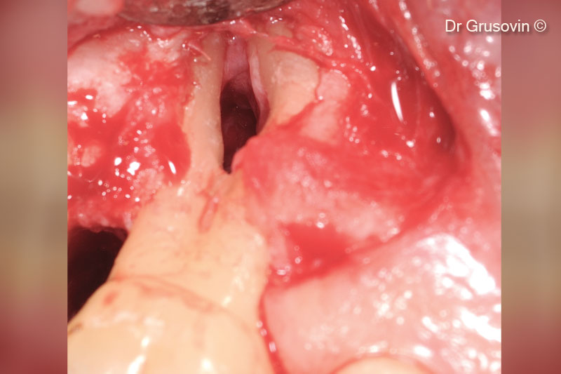 4. Clinical view during surgery: vestibular and distal furcation III involvement