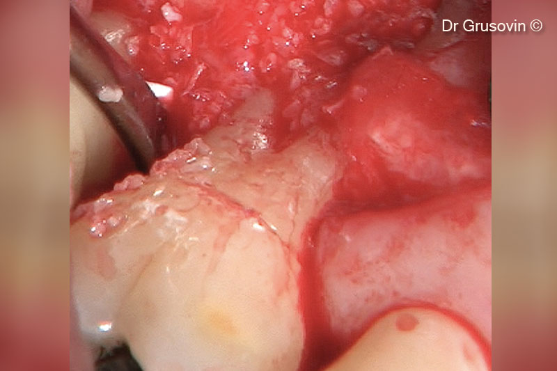 6. OsteoBiol® Gen-Os® inserted distally