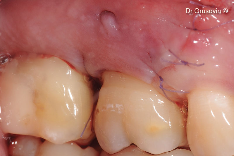 7. Closure of papilla preservation flap