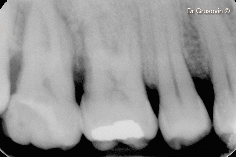 8. X-ray at 1 year follow-up