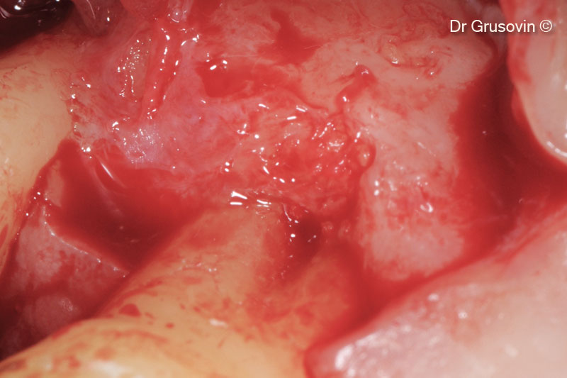 9. Bone formation in #16 furcation defect at 1 year follow-up