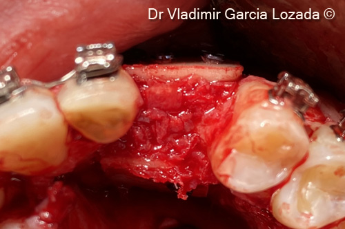 12. Bone defect filling inside the 2 OsteoBiol® Soft Cortical Laminas with autogenous bone chips