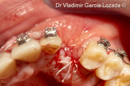 14. Management of soft tissues and flap closure using 5-0 PTFE suture