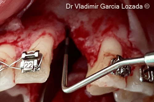 5. Measurement of the defect with a deep probe
