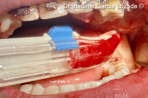 9. Recollection of autogenous bone chips with a safescraper from the mandibular ramus