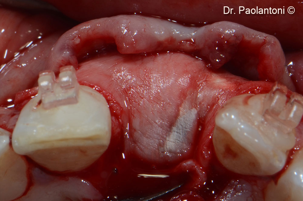 An Evolution collagen membrane is fixed with titanium pins