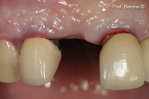 Soft Tissue Healing after 6 months