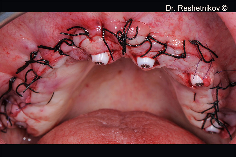 Suturing around installed abutments