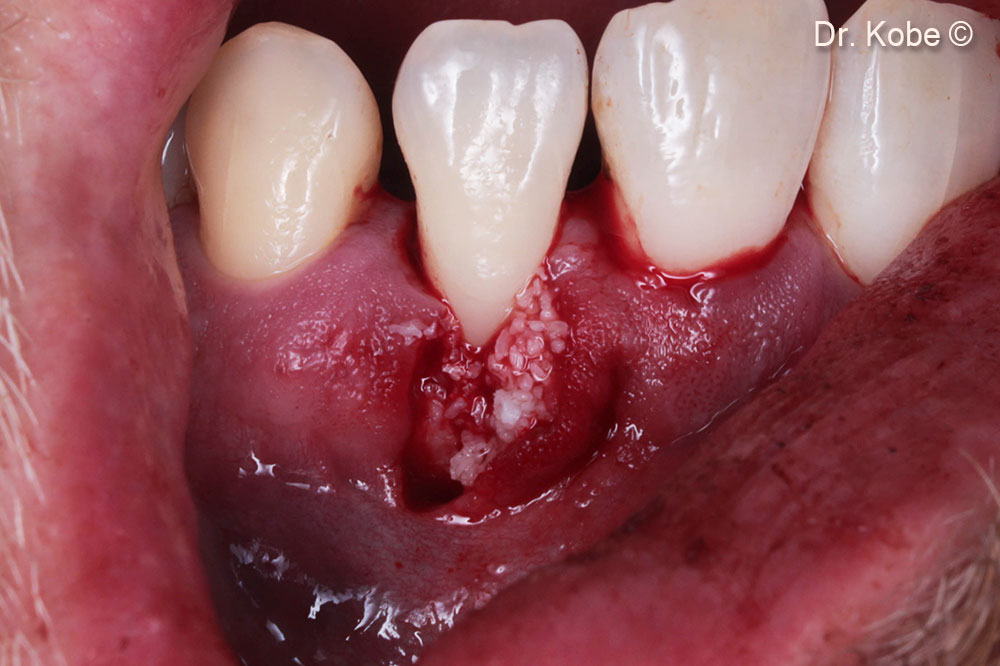 Defect filled with Gen-Os®