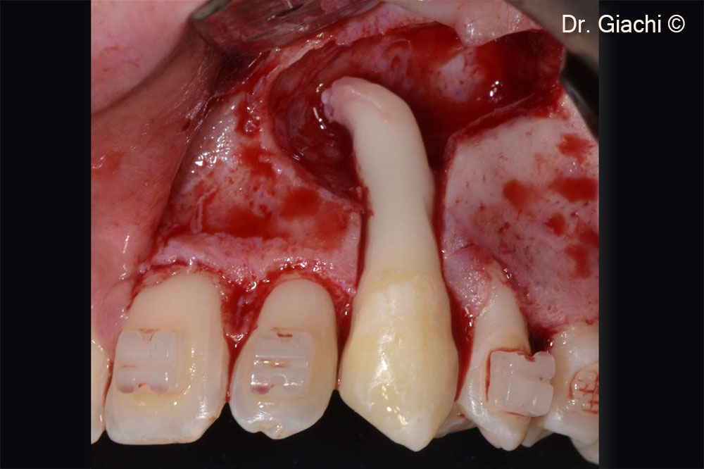 Canine positioning after surgical alveolus design
