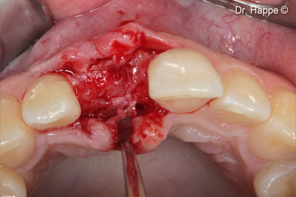 Occlusal view of the regenerated ridge