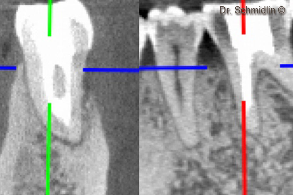 CBCT of the mesial root after 6 months