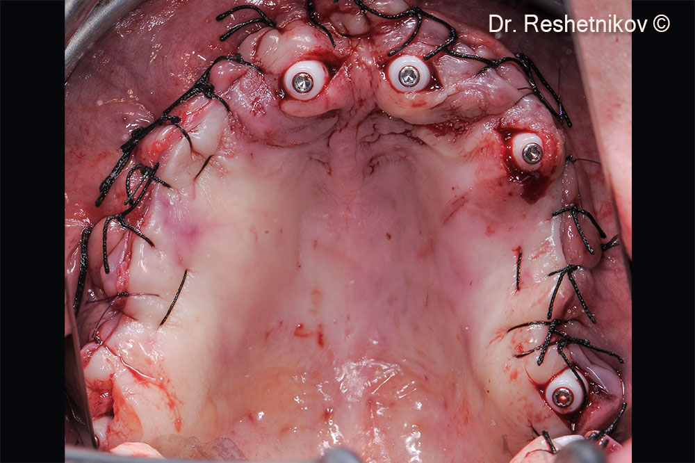 Suturing around installed abutments