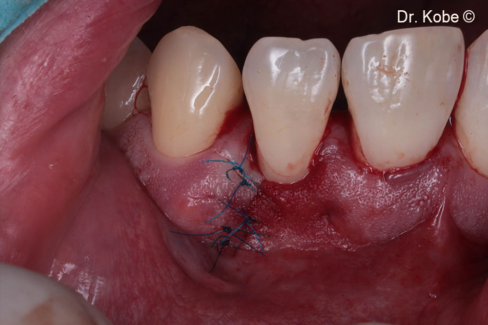 Wound sutured with interrupted sutures