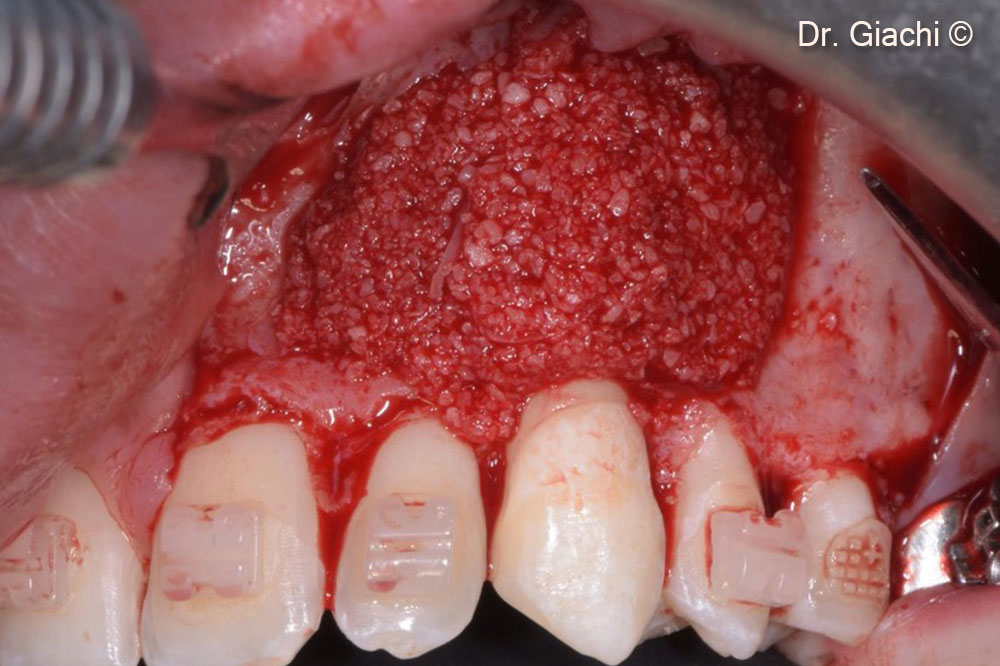 Bone reconstruction with fully resorbable collagenated biomaterial – vestibular view